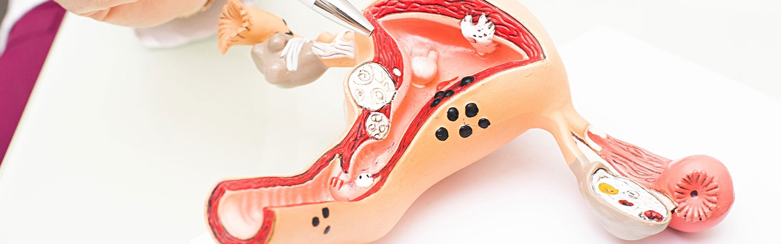 Cirurgias dos ovários: Ooforoplastia e Oofotectomia - Instituto Feminina